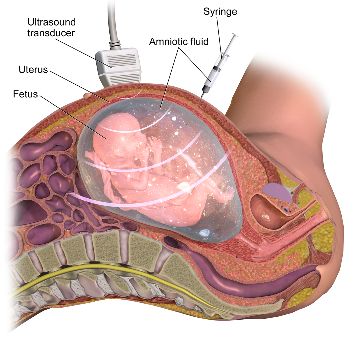 Amniocentesis Prenatal Diagnostic Test